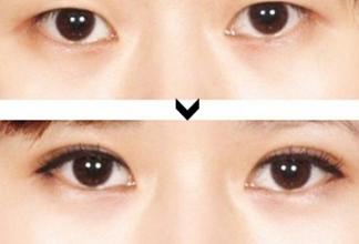 韩式双眼皮对比照