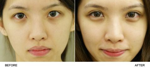 韩式双眼皮对比照