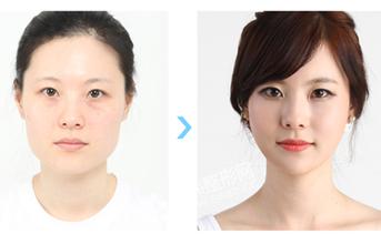 改脸型手术对比照