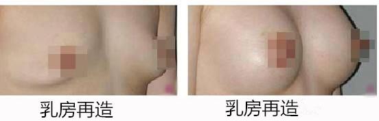 乳房再造对比照