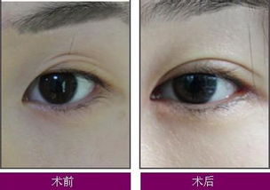 双眼皮修复有几种分类 - 珍美网