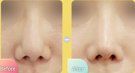 影响鼻部修复手术价格的因素有哪些 - 珍美网