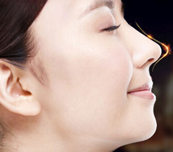 隆鼻不仅仅是胶体植入 总有一款类型适合你 - 珍美网