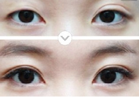双眼皮失败修复术的效果怎么样 - 珍美网