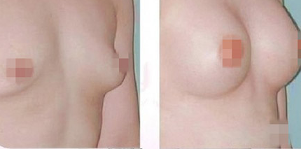 自体脂肪移植隆胸有什么优点 - 珍美网