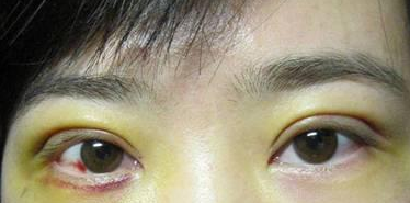 双眼皮手术 发现双眼皮的魅力好大 - 珍美网