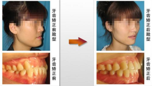 牙套矫正地包天效果怎么样 - 珍美网