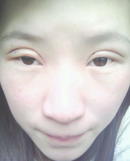 韩式双眼皮手术  让我眼睛更加闪亮 - 珍美网
