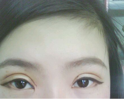 韩式双眼皮手术  让我眼睛更加闪亮 - 珍美网