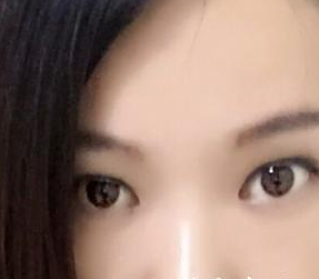 北京凯润婷医疗美容医院赵洋医生嫩肤案例：我的彩光嫩肤历程