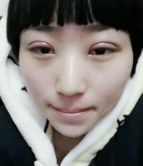 南京医科大学第二附属医院整形美容中心李昌医生割双眼皮案例：割 - 珍美网