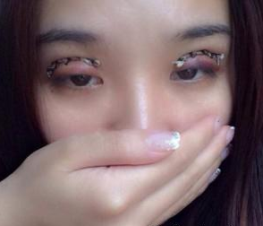 北京圣嘉新医疗美容门诊部朱昊医生割双眼皮案例：实现美丽的自己 - 珍美网