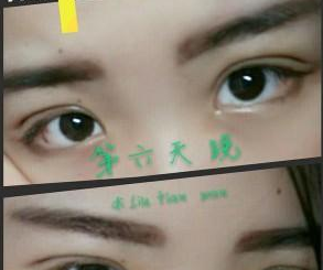 北京叶美人医疗美容诊所余森林医生割双眼皮案例：人都夸我美美了 - 珍美网