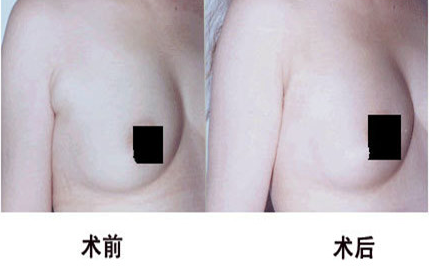 副乳切除后效果怎么样呢? - 珍美网