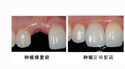 种植牙要如何保养寿命更长 - 珍美网