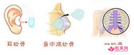 自体软骨隆鼻用的是哪里的软骨
