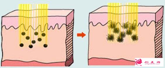 皮秒祛斑恢复过程图