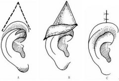 做耳部畸形整形以后功效天然吗？