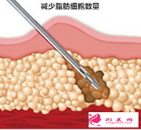 抽脂减肥的大致过程及术后症状