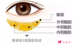 手术切除眼袋后眼眶凹陷怎么回事?