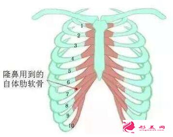 自体软骨隆鼻的恢复时间