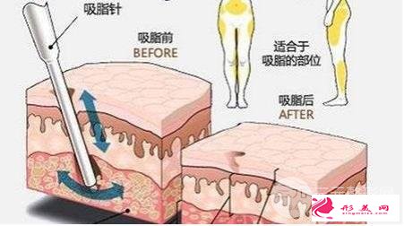 大腿吸脂减肥部位