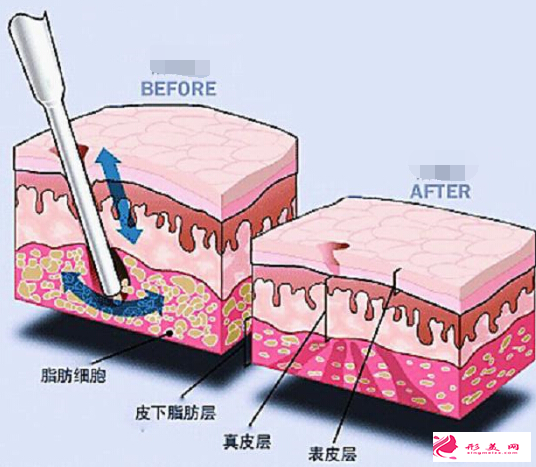 大腿吸脂后对正常运动有影响吗