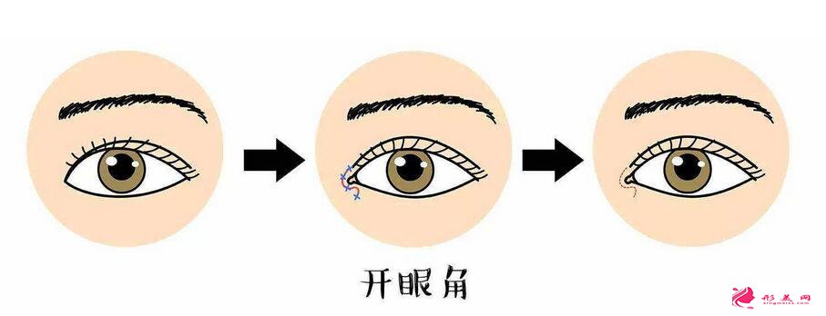 适合开眼角