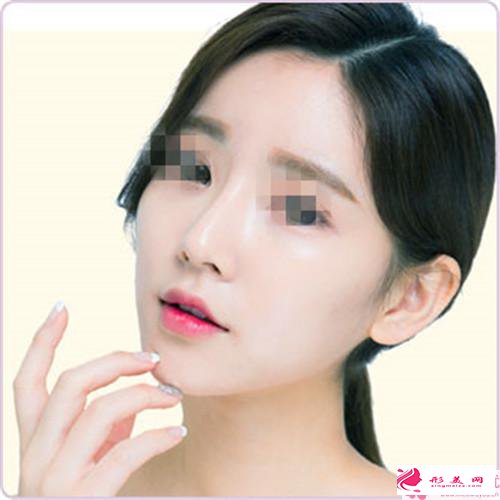 自体隆鼻手术适合哪类人(Autogenous rhinoplasty)