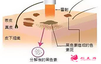 激光祛黄褐斑后会反弹吗