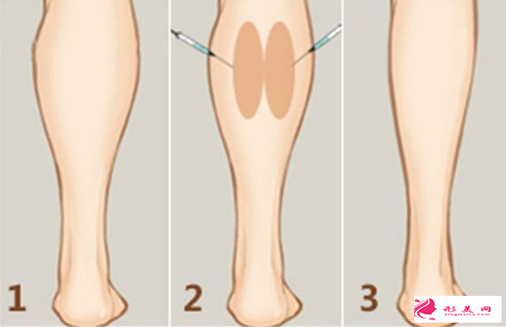 广州打瘦腿针的大概价格