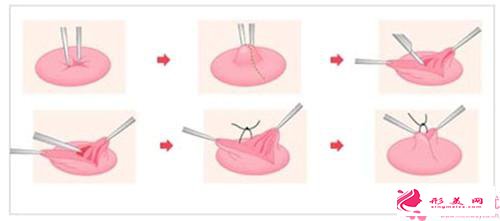  乳头缩小手术失败后怎么办_解决乳头缩小手术失败的方法