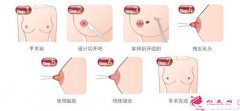 乳头内陷矫正手术需要多少钱？