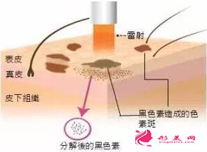 打了玻尿酸还能做激光祛斑吗