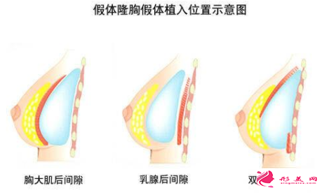 隆胸假体放置的位置