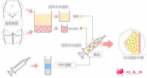 抽脂丰胸的手术原理是什么?