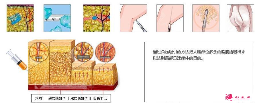 吸脂瘦大腿肿胀期是多久？多久能看到效果？