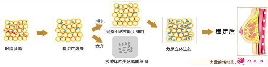 自体隆胸手术原理