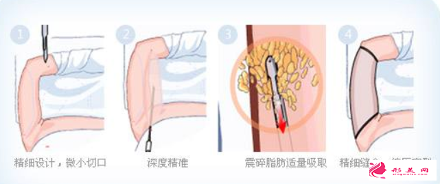 大腿吸脂要注意哪些问题