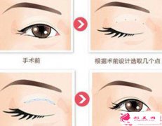 鼻整形手术价格多少钱？