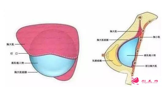 进口假体隆胸品牌有哪些？看完科普你就知道了~