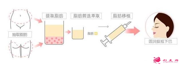 垫下巴多少钱？三种不同垫下巴方式速来Get!