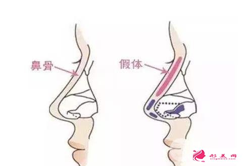 假体隆鼻怎么样?