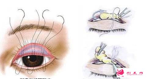 专业双眼皮手术费用