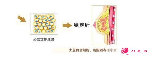 自体脂肪移植隆胸费用