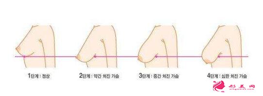 郑州星艺乳房下垂矫正方法有几种