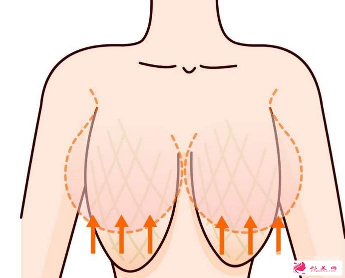 胸部下垂整形要多少钱？胸部下垂整形手术方式有很多~