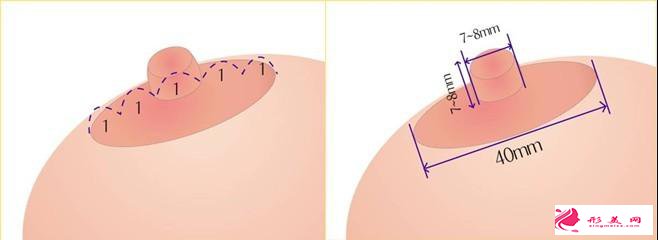 哪些女性是需要做乳晕再造手术的呢