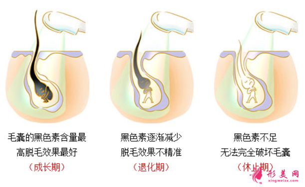 激光脱毛会有损伤皮肤吗