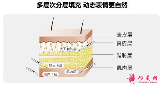 大腿抽脂填充脸部手术风险有哪些？